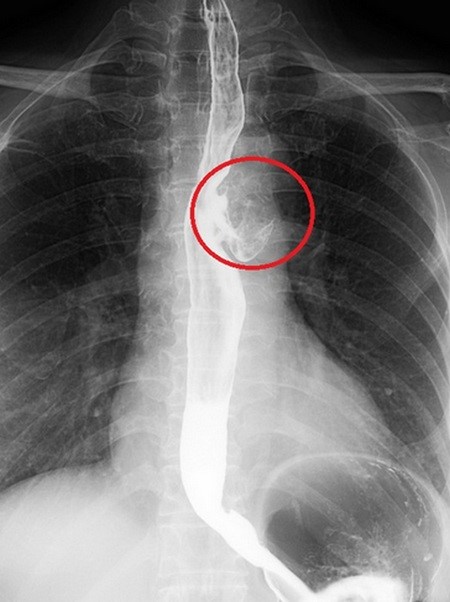 口腔異味重竟是食道憩室 胸腔鏡手術解除多年困擾