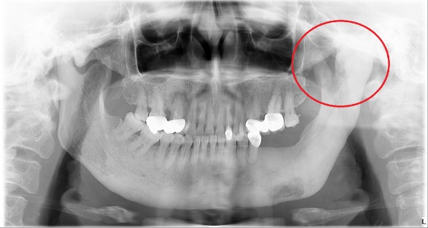 骨骼異常增生致無法張嘴 首例顎骨冷凍治療結合3D導航解噩夢