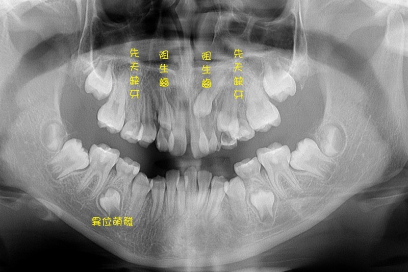 20241008-先天異常致女童缺牙亂牙　早期矯正提升自信心