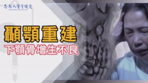 Read more about the article 【志為人醫守護愛】顳顎重建雙贏▪後篇-頭痛、下巴痛忍了19年 罕病骨纖維增生不良｜臺灣首例下顎骨冷凍手術重建