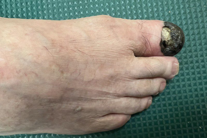 以為瘀青竟是罹癌 醫師籲重視皮膚變化20250708 1
