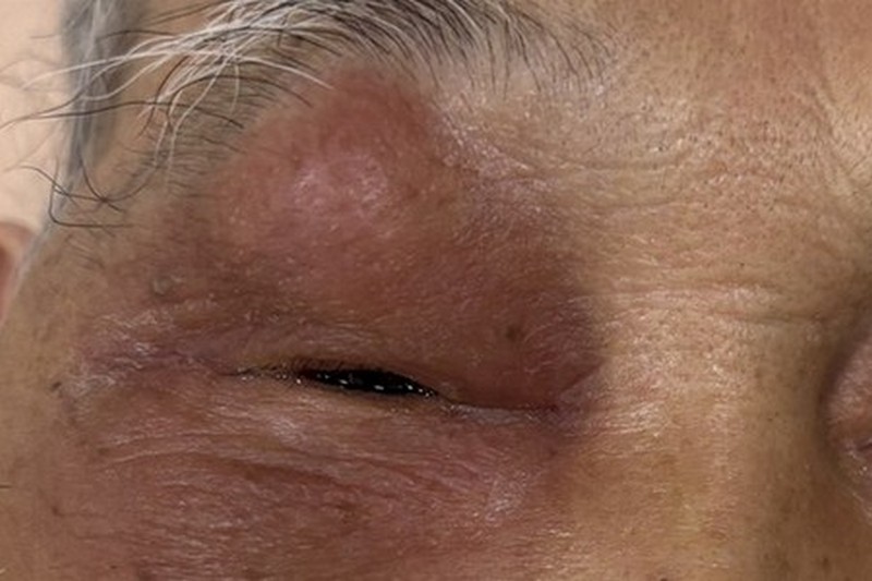 眼睛腫痛竟是鼻竇炎 內視鏡及引流手術解除病灶 20250820 1