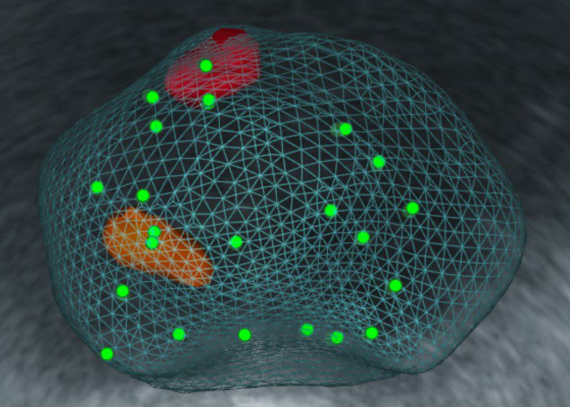 排尿不順竟是攝護腺癌晚期 達文西根除手術成功去除病灶 20251103 1