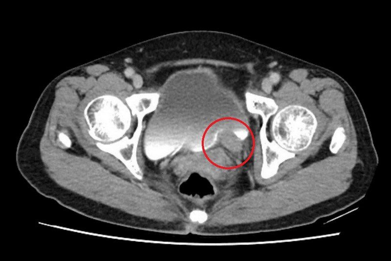 無痛血尿竟是罹癌 手術化療並行根除病灶 20251030 1