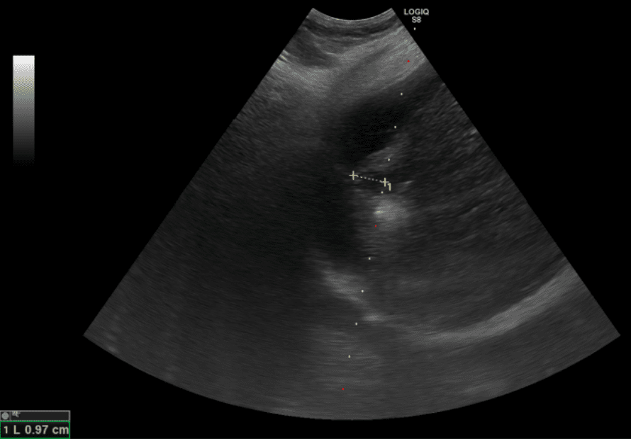 肝功能異常竟是肝癌 電燒治療去腫瘤保肝臟 20251021 1