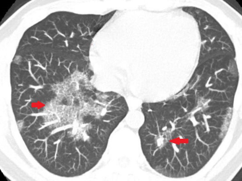 肺部白影非肺炎！竟是蛋白質沉積症 全肺灌洗恢復健康呼吸 20250827 1