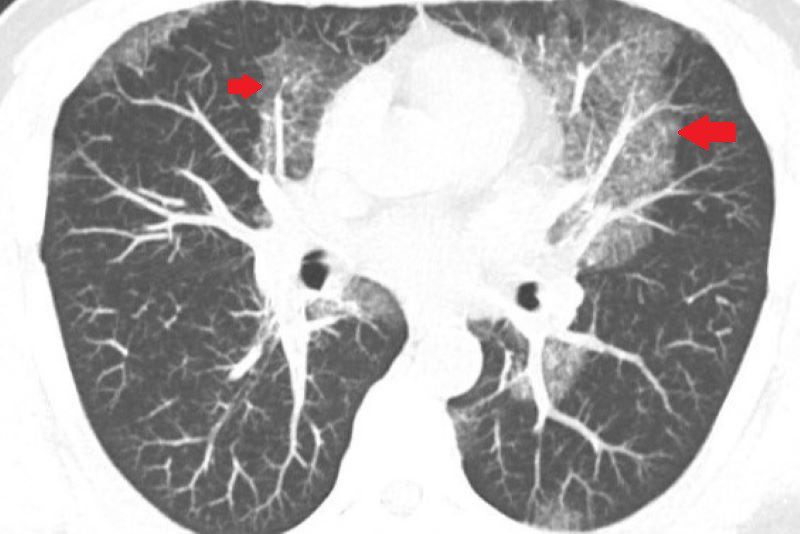 肺部白影非肺炎！竟是蛋白質沉積症 全肺灌洗恢復健康呼吸 20250827 2