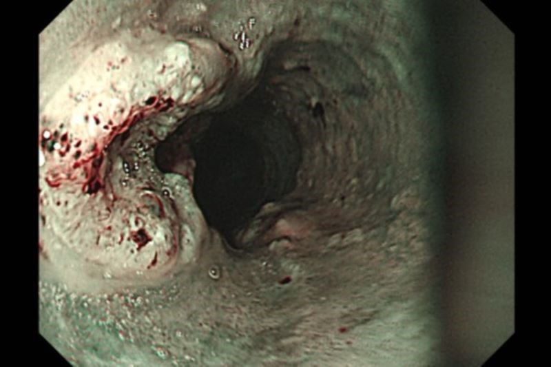 食道癌合併下咽癌 胸腔鏡微創食道切除術免永久氣切 20251119 1