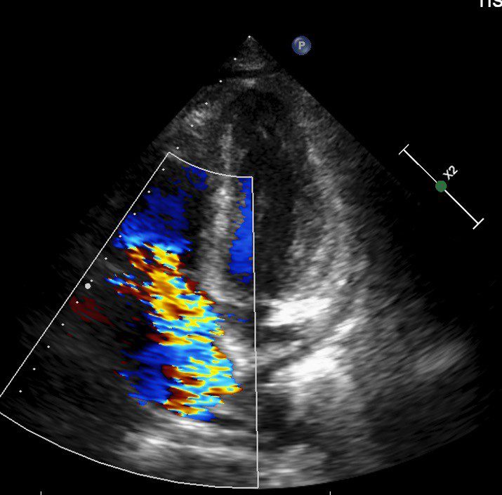 反覆發燒血球異常 三尖瓣重度逆流致脾臟腫大 20251224 2