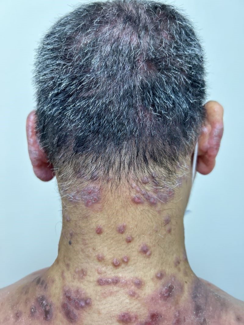 異位性皮膚炎搔癢難以入眠 標靶藥物治療恢復生活品質 20251205 1