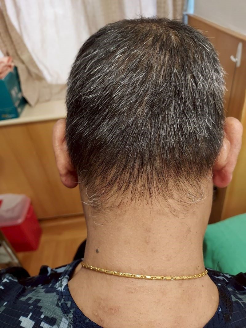 異位性皮膚炎搔癢難以入眠 標靶藥物治療恢復生活品質 20251205 2