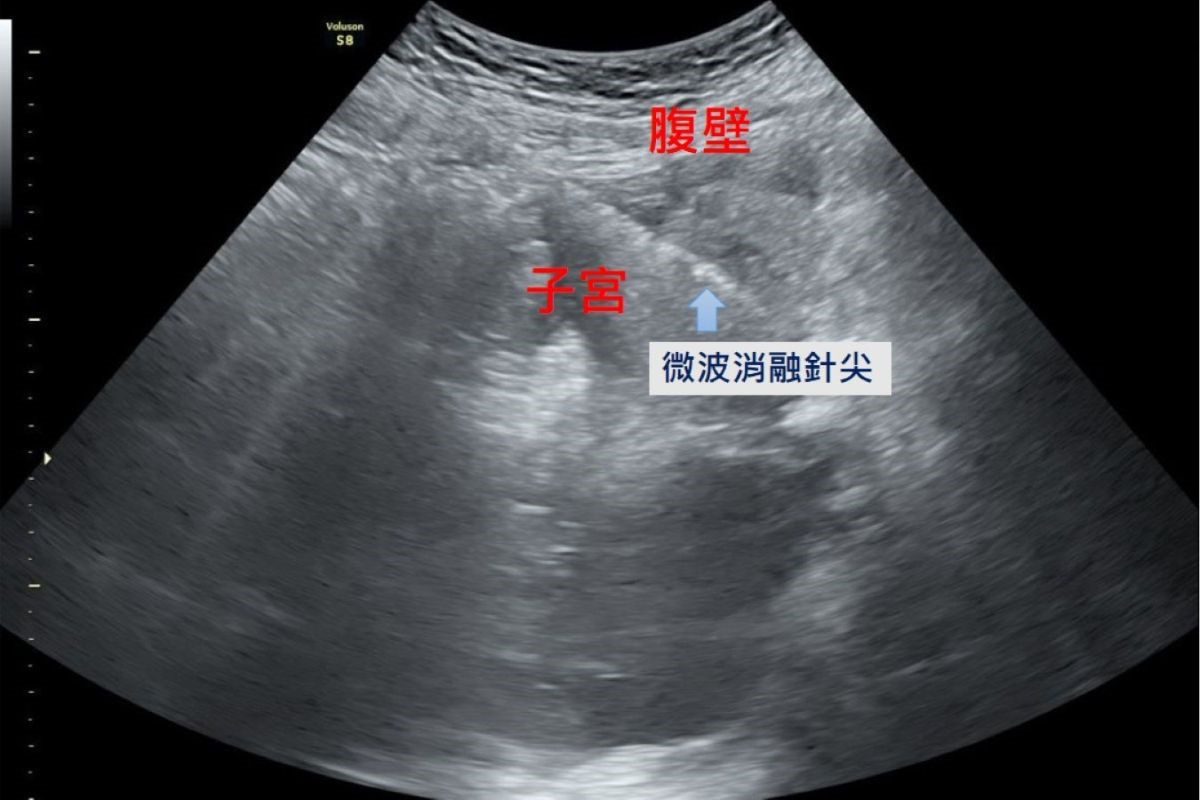 經痛難耐原是子宮肌腺瘤作祟 微波消融手術治療解除病灶 20251125 1