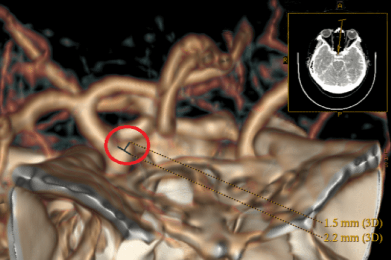 四旬婦動脈瘤二次破裂 夾閉手術搶回一命 20260120 1