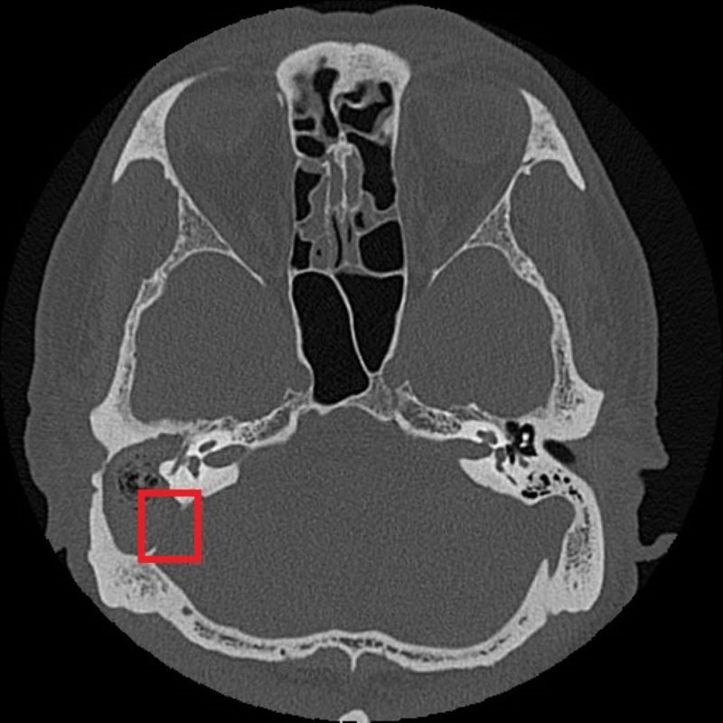 慢性中耳炎勿輕忽 併發膽脂瘤造成聽力與神經損傷 20260121 1