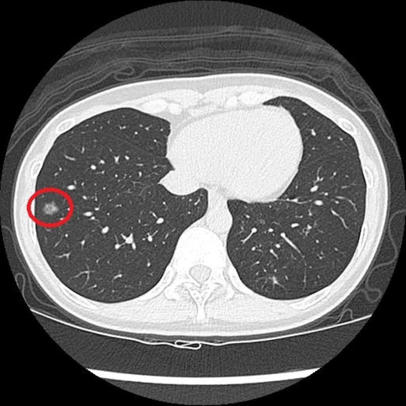 早期肺癌難察覺 LDCT揪出病灶 20260115 1