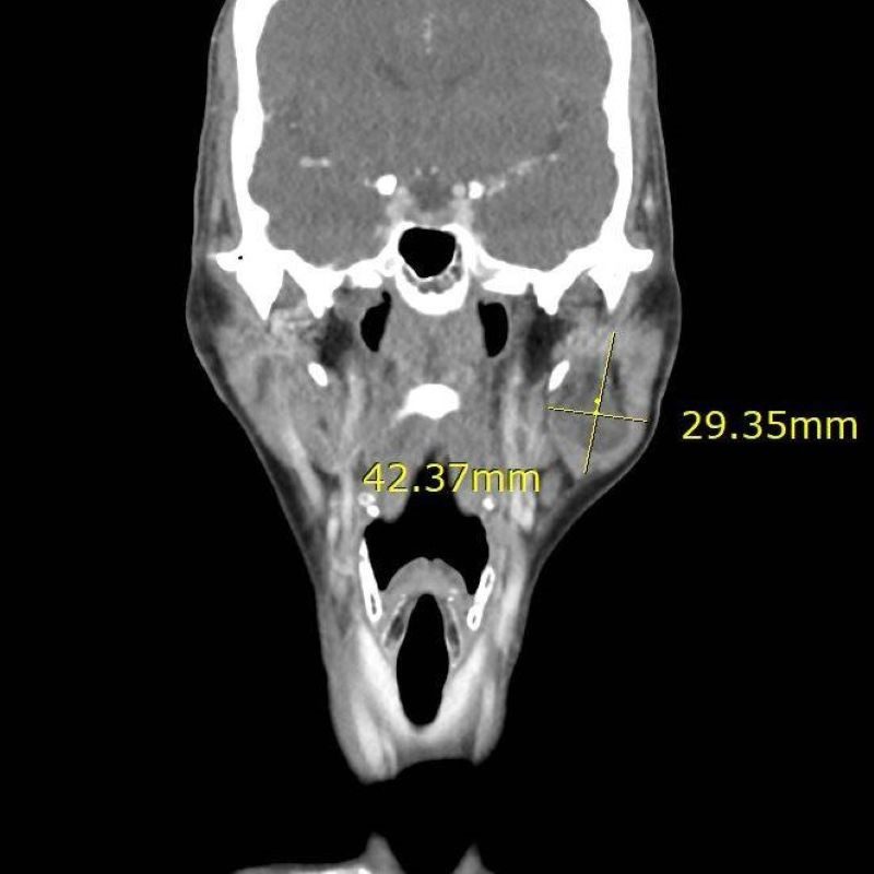 罕見腮腺癌影響臉部外觀 切除修補手術找回自信 20260114 1