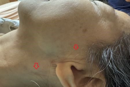 罕見腮腺癌影響臉部外觀 切除修補手術找回自信 20260114 2