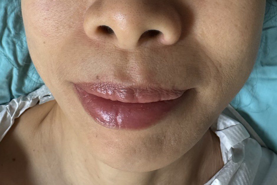 罕見腮腺癌影響臉部外觀 切除修補手術找回自信 20260114 3