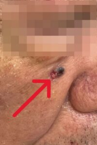 臉上黑斑竟是皮膚基底細胞癌 日常防曬可降低癌變機率 20260120 1