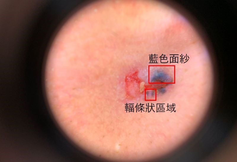 臉上黑斑竟是皮膚基底細胞癌 日常防曬可降低癌變機率 20260120 3