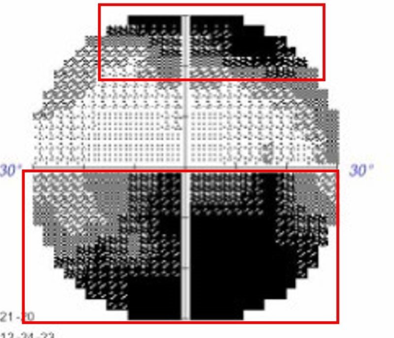 不只是用眼過度 視力模糊藏疾病警訊 20260127 2