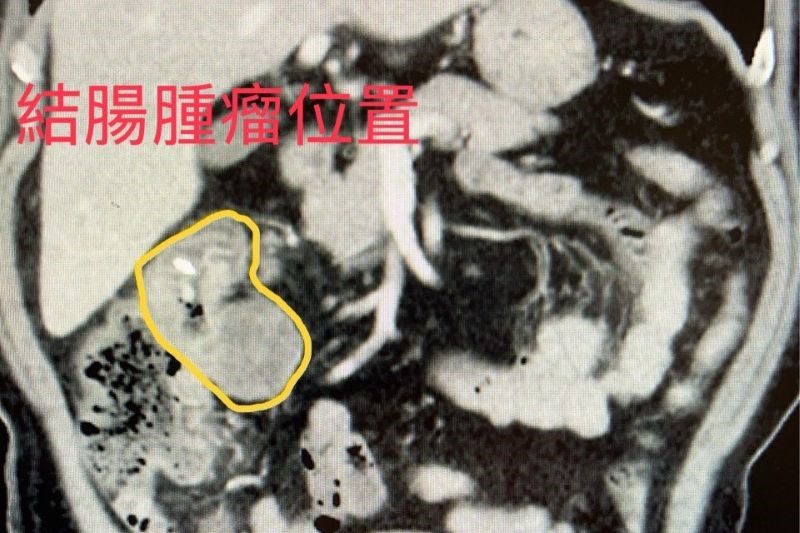 高油鹽飲食埋大腸癌隱憂 醫籲定期接受i FOBT免疫法篩檢 20260205 1