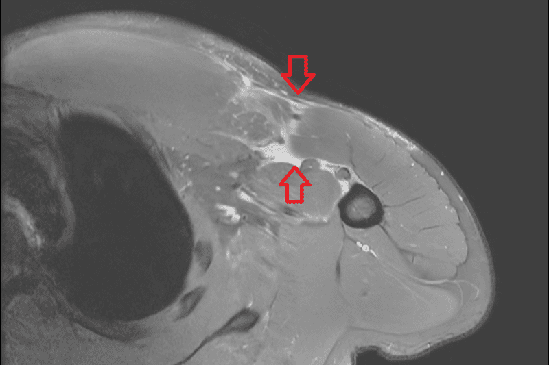 健身胸痛竟是肌腱斷裂 縫合手術重拾力量 20260224 1