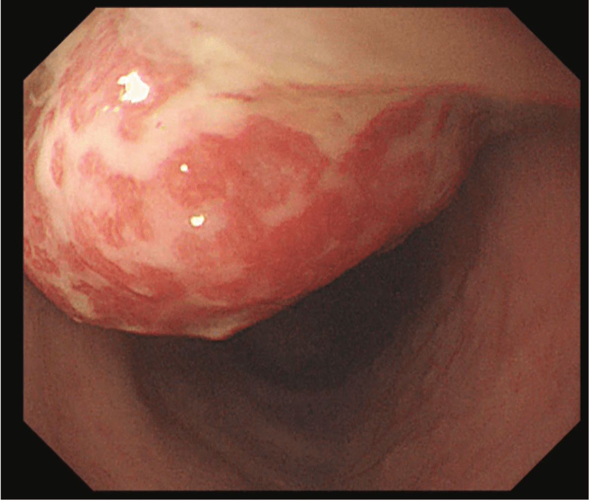 兒童血便不只是便秘 大腸鏡微創手術切除息肉 20260317 1