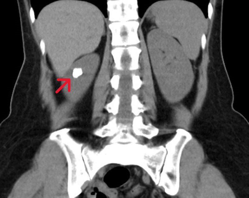 尿道感染竟是罕見腎盞憩室結石 微創手術成功取石 20260313 1