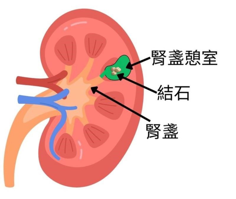 尿道感染竟是罕見腎盞憩室結石 微創手術成功取石 20260313 2 尿道感染竟是罕見腎盞憩室結石 微創手術成功取石 20260313 2