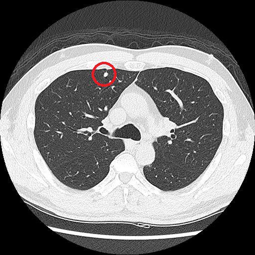 LDCT揪出肺部微小病灶 精準定位助微創治療 20260408 1