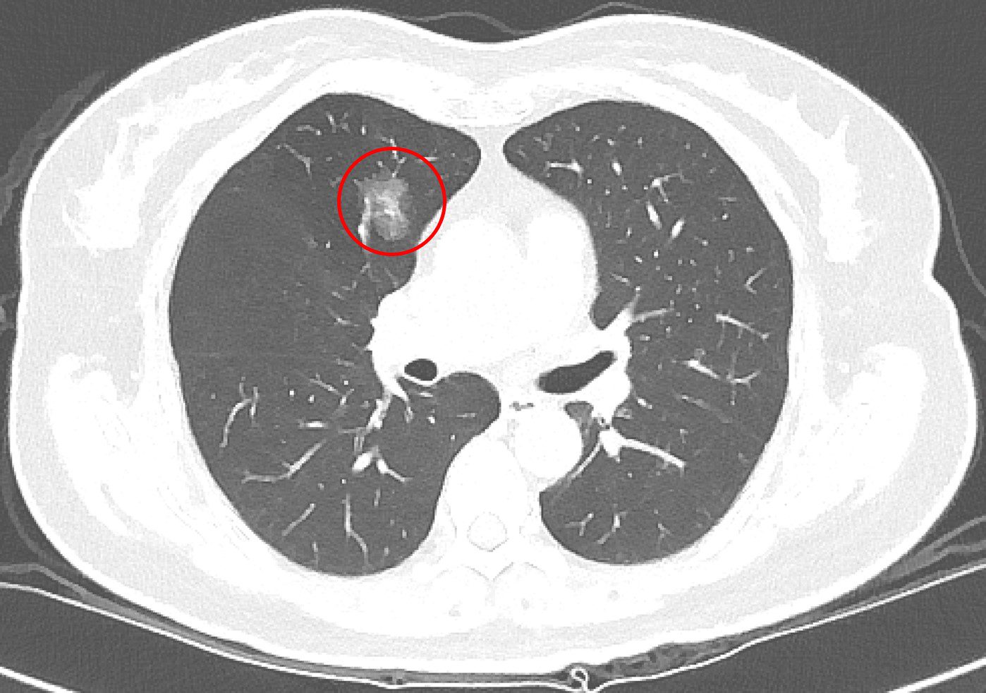 北慈研究發現LDCT篩出結節 20260417 1