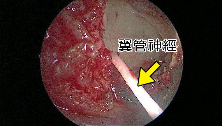過敏性鼻炎手術卻復發 翼管神經阻斷術改善多年困擾 20260605 1