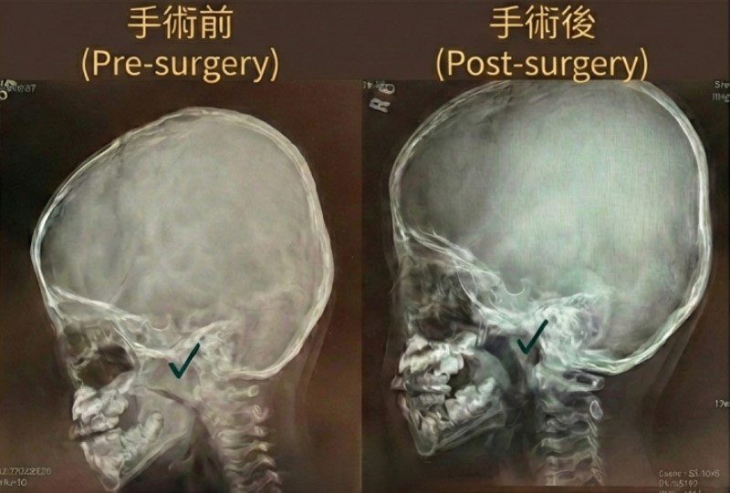 兒童鼻塞影響發育別輕忽 手術提升鼻腔通氣順暢 20260908 1