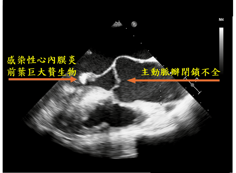 九旬翁瓣膜逆流引發心臟衰竭 全內視鏡雙瓣膜置換手術救命 20261007 1