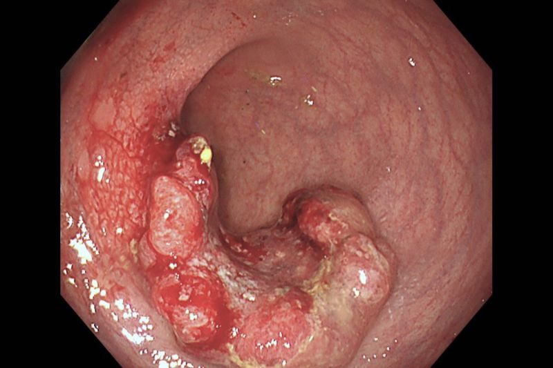 無症狀篩出大腸癌 醫師提醒：別等有症狀才檢查 20261016 2